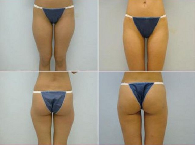 липосакция body jet что это. Смотреть фото липосакция body jet что это. Смотреть картинку липосакция body jet что это. Картинка про липосакция body jet что это. Фото липосакция body jet что это