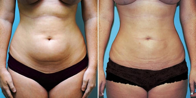 липосакция body jet что это. Смотреть фото липосакция body jet что это. Смотреть картинку липосакция body jet что это. Картинка про липосакция body jet что это. Фото липосакция body jet что это