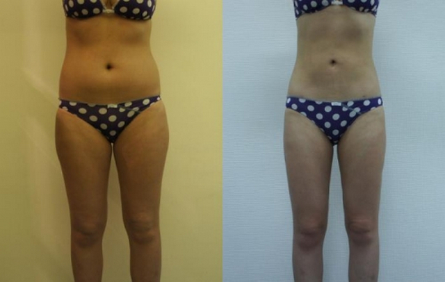 липосакция body jet что это. Смотреть фото липосакция body jet что это. Смотреть картинку липосакция body jet что это. Картинка про липосакция body jet что это. Фото липосакция body jet что это