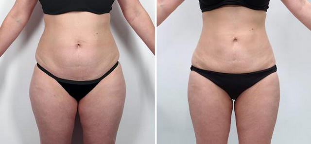 липосакция body jet что это. Смотреть фото липосакция body jet что это. Смотреть картинку липосакция body jet что это. Картинка про липосакция body jet что это. Фото липосакция body jet что это