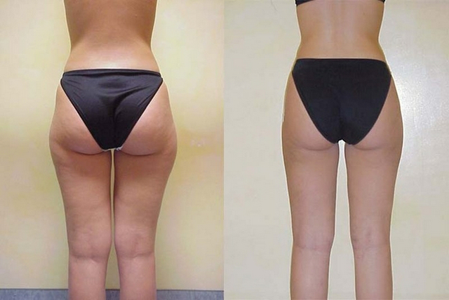 липосакция body jet что это. Смотреть фото липосакция body jet что это. Смотреть картинку липосакция body jet что это. Картинка про липосакция body jet что это. Фото липосакция body jet что это