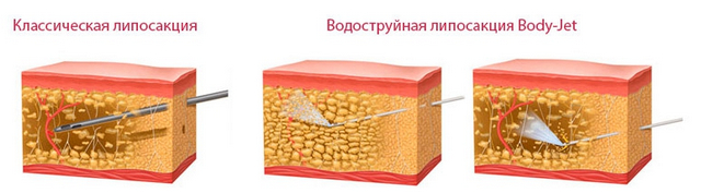 липосакция body jet что это. Смотреть фото липосакция body jet что это. Смотреть картинку липосакция body jet что это. Картинка про липосакция body jet что это. Фото липосакция body jet что это