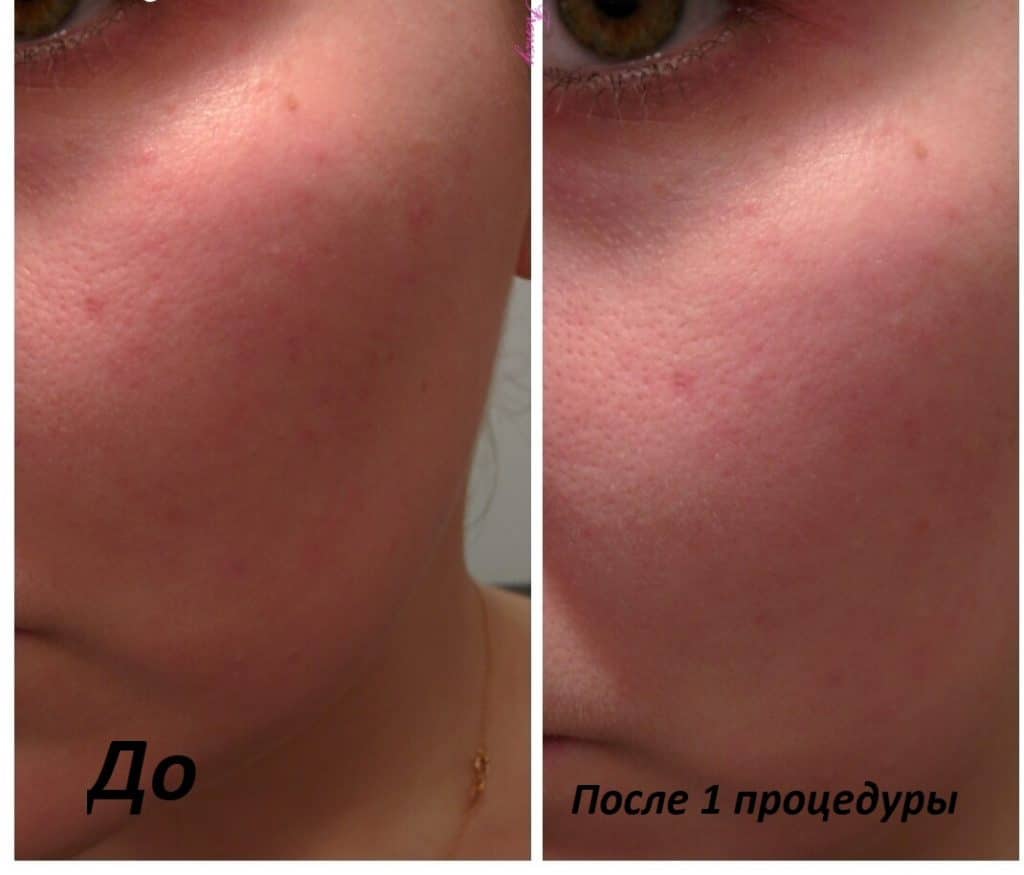 Что такое пилинг скатка для лица как ей пользоваться. Смотреть фото Что такое пилинг скатка для лица как ей пользоваться. Смотреть картинку Что такое пилинг скатка для лица как ей пользоваться. Картинка про Что такое пилинг скатка для лица как ей пользоваться. Фото Что такое пилинг скатка для лица как ей пользоваться Что такое пилинг скатка для лица как ей пользоваться. Смотреть фото Что такое пилинг скатка для лица как ей пользоваться. Смотреть картинку Что такое пилинг скатка для лица как ей пользоваться. Картинка про Что такое пилинг скатка для лица как ей пользоваться. Фото Что такое пилинг скатка для лица как ей пользоваться