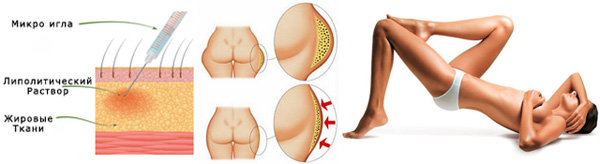 мезотерапия тела и бедер