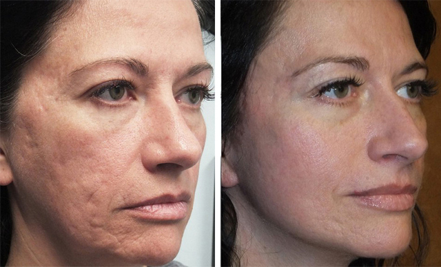 Как влияет плазмолифтинг на кожу лица thumbnail