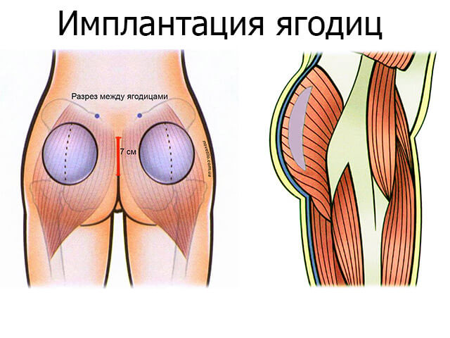 Увеличение ягодиц - ГБУ НИИ СП им. И.И.Джанелидзе