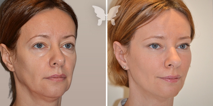 Подтяжка средней трети лица фото до и после