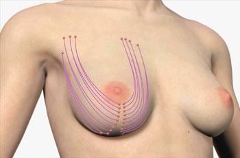 Подтяжка грудных желез без имплантов противопоказания thumbnail