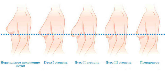 степени птоза молочной железы