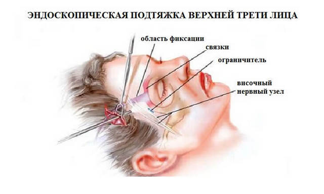 подтяжка верхней трети лица