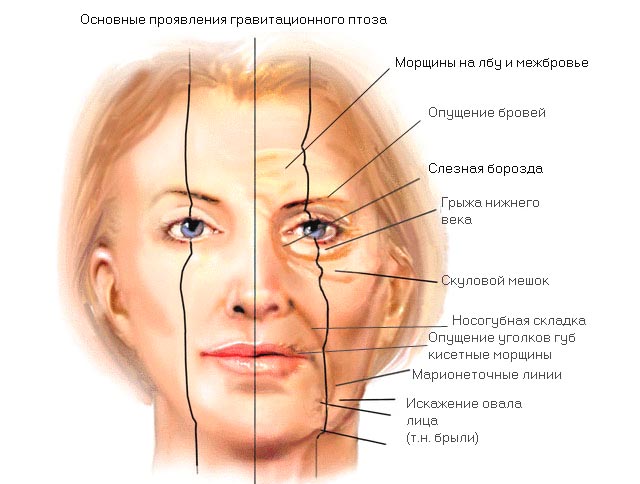 признаки птоза и старения кожи