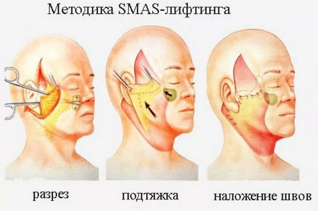 разрезы при операции смас лифтинга лица