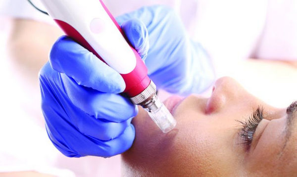 Фракционная мезотерапия лица - достоинства процедуры и эффект