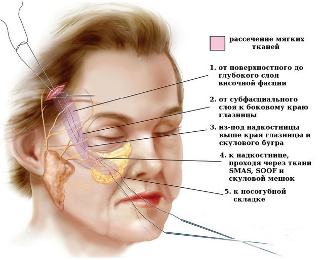 технология чек-лифтинга лица