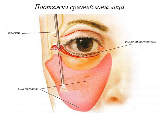 эндоскопическая подтяжка лица