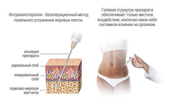 интралипотерапия