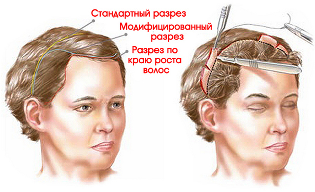 операциооные методы подтяжки лба