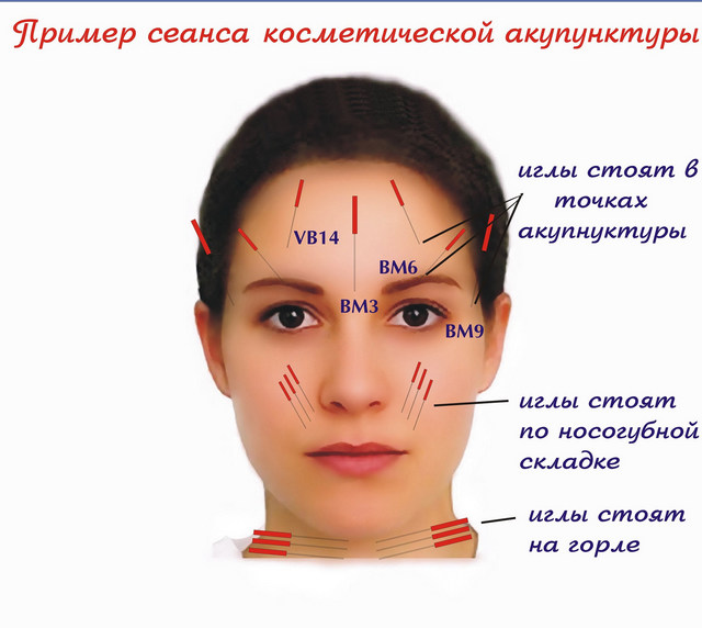 техника иглоукалывания лица