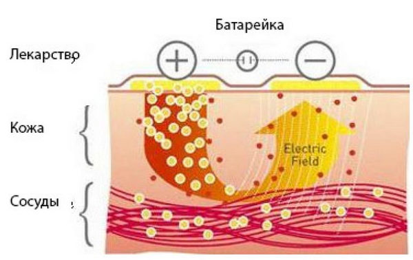 как действует ионофорез