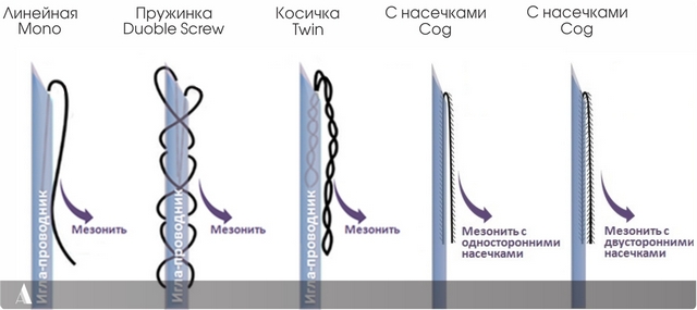 типы мезонитей для подтяжки лица