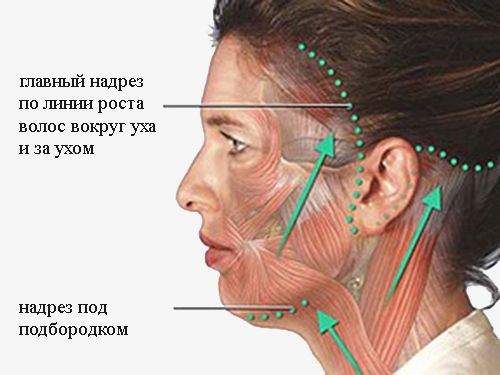 разрезы при ритидэктомии