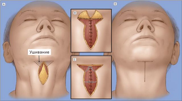 цервикопластика шеи