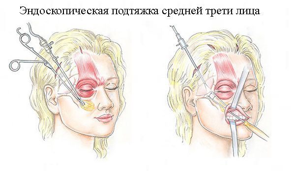 эндоскопическая подтяжка лица