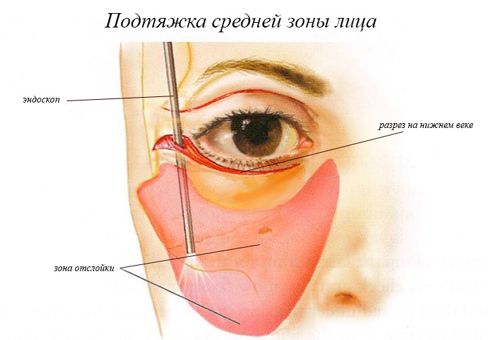 подтяжка средней трети лица