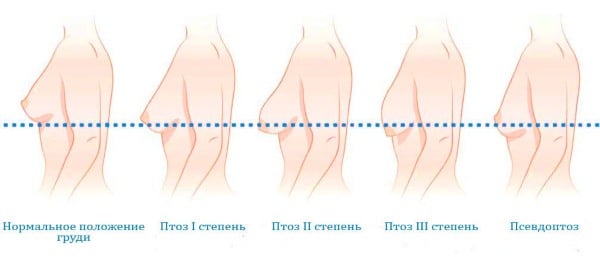 Стадии птоза молочных желез