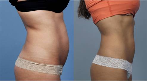Body tite липосакция - фото после проведения процедуры