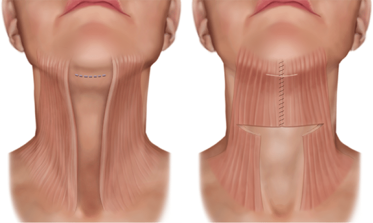Латеральная и медиальная платизмопластика