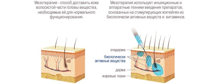 Что такое мезотерапия. Принцип действия