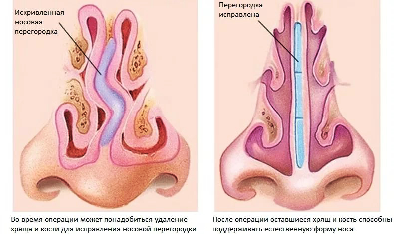 Что такое септопластика и зачем ее делают