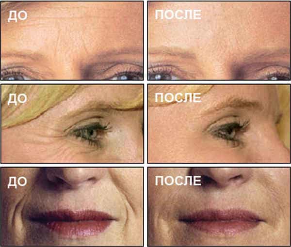 фото до и после биоревитализации