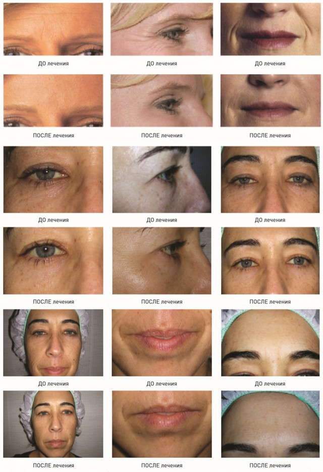 фото до и после биоревитализации