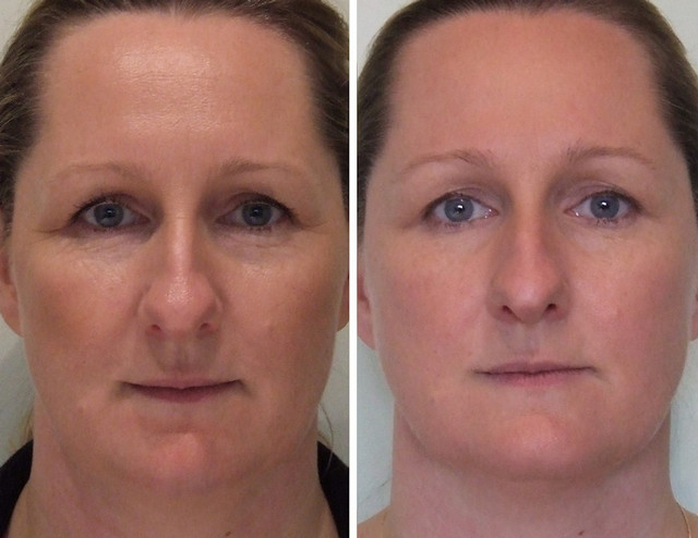 фото до и после микротоков лица