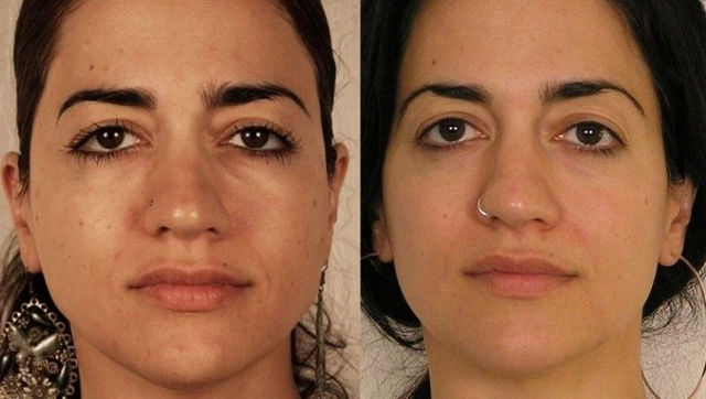 фото до и после микротоков лица