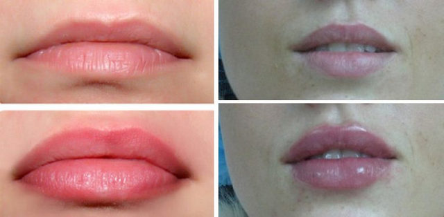 фото до и после биоревитализации губ