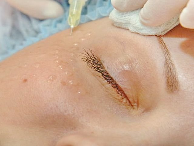 процедура биоревитализации глаз