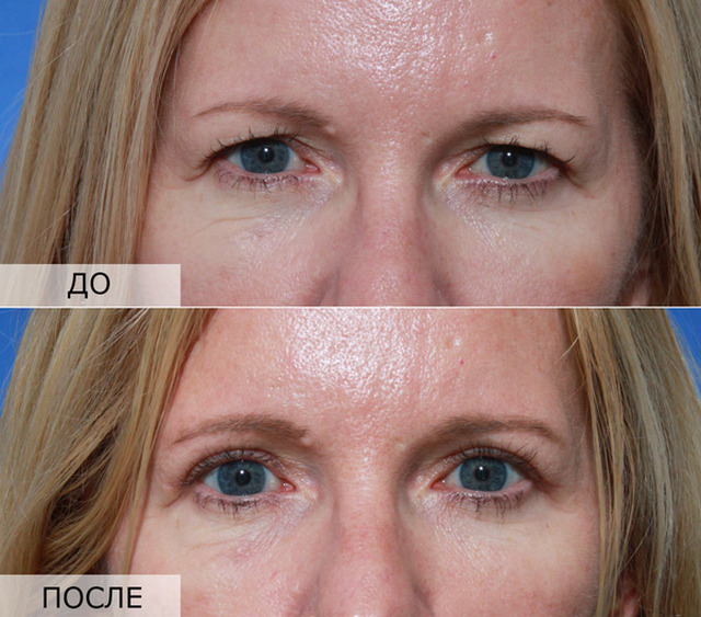 фото до и после лазерной блефаропластики