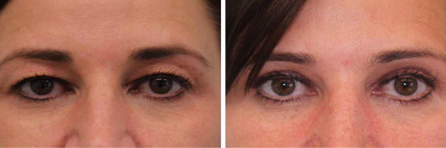 фото до и после лазерной блефаропластики
