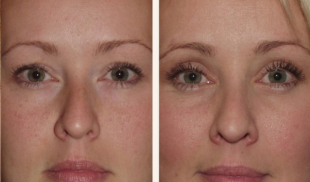 фото до и после лазерной блефаропластики