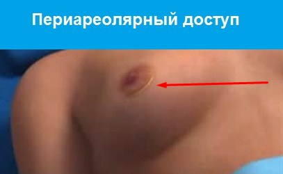 шрам после подтяжки груди периареолярным методом