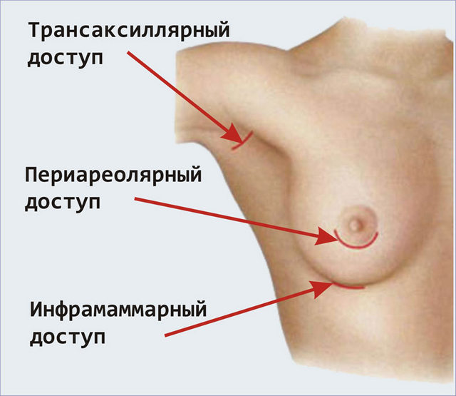 виды разрезов для подтяжки груди