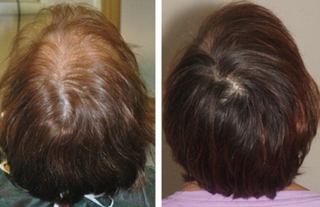 фото до и после плазмолифтинга волос