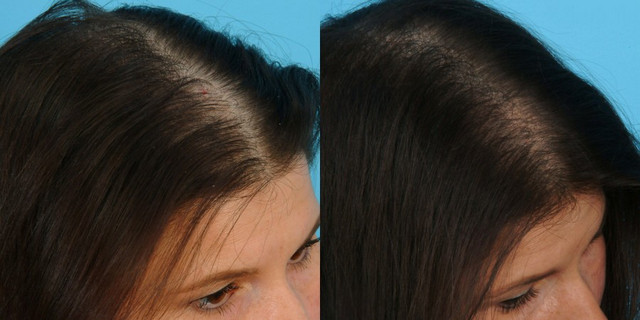 фото до и после плазмолифтинга волос