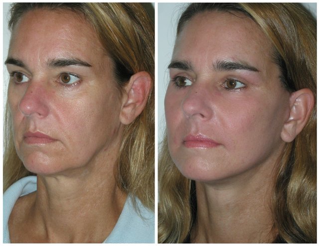 фото до и после мезонитей для лица