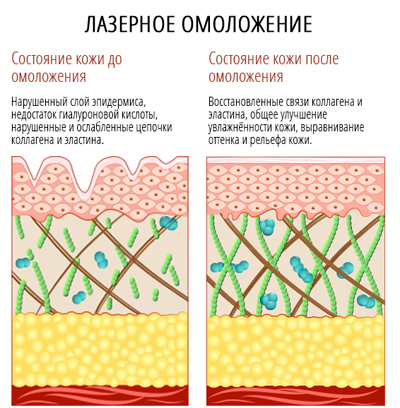 как действует омоложение лазером на кожу