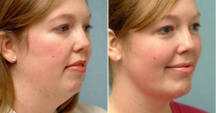 фото до и после подтяжки лица