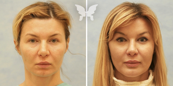 фото до и после подтяжки средней части лица